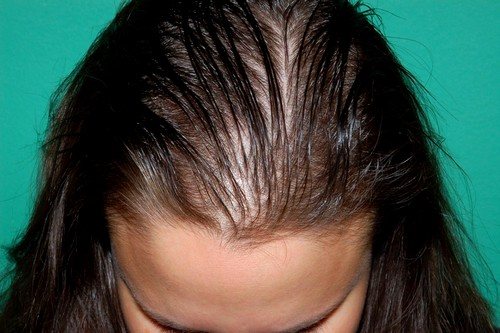 Диффузное выпадение волос (алопеция) проявляется в прореживании волос по всей площади волосяного покрытия головы с примерно одинаковой интенсивностью