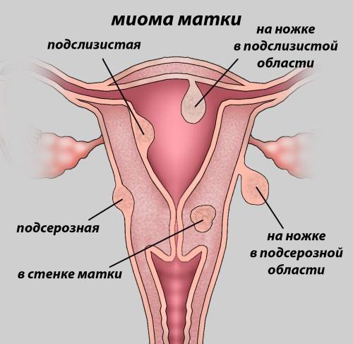 Экстракт водяного перца для сокращения матки: инструкция по применению, плюсы и минусы