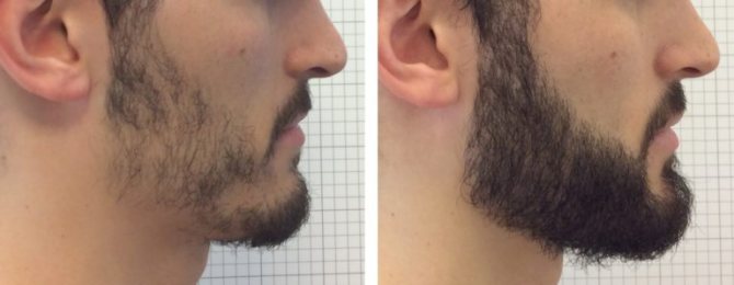 пересадка бороды и усов