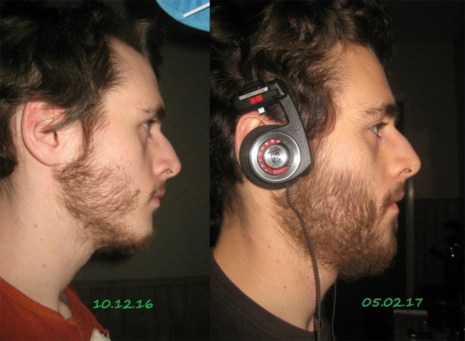 Репейное масло для бороды: вид до и после использования