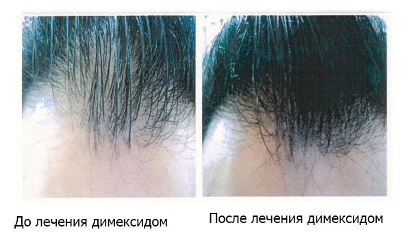 Рост волос при применении димексида