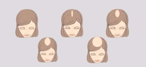 Выпадение волос причины и лечение у женщин
